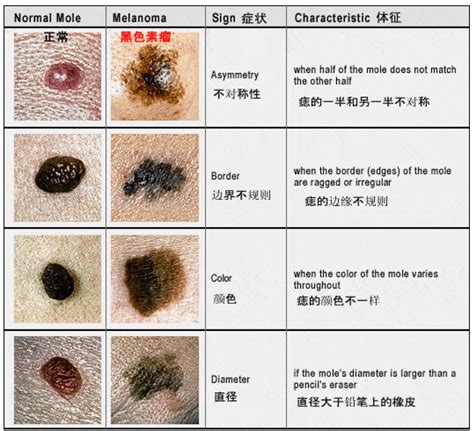 胸部長痣乳癌|痣也可能会癌变！长在 3 个地方要注意